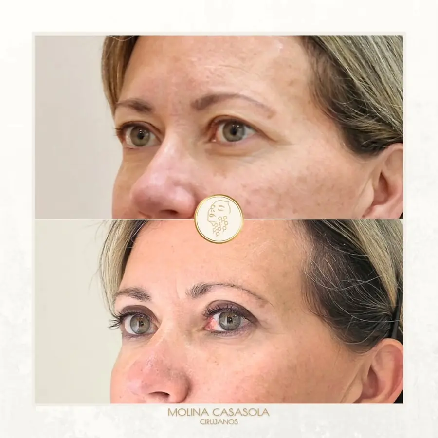 Antes y después de blefaroplastia superior, paciente de la clínica