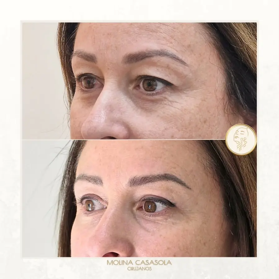 Antes y después de blefaroplastia superior, paciente de la clínica