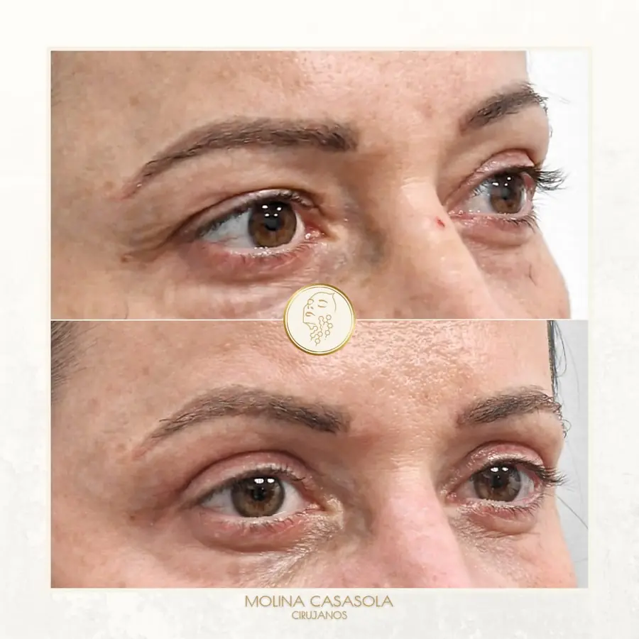 Antes y después de blefaroplastia superior, paciente de la clínica