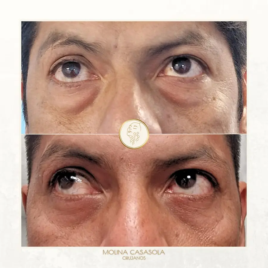 Antes y después de blefaroplastia inferior, paciente de la clínica