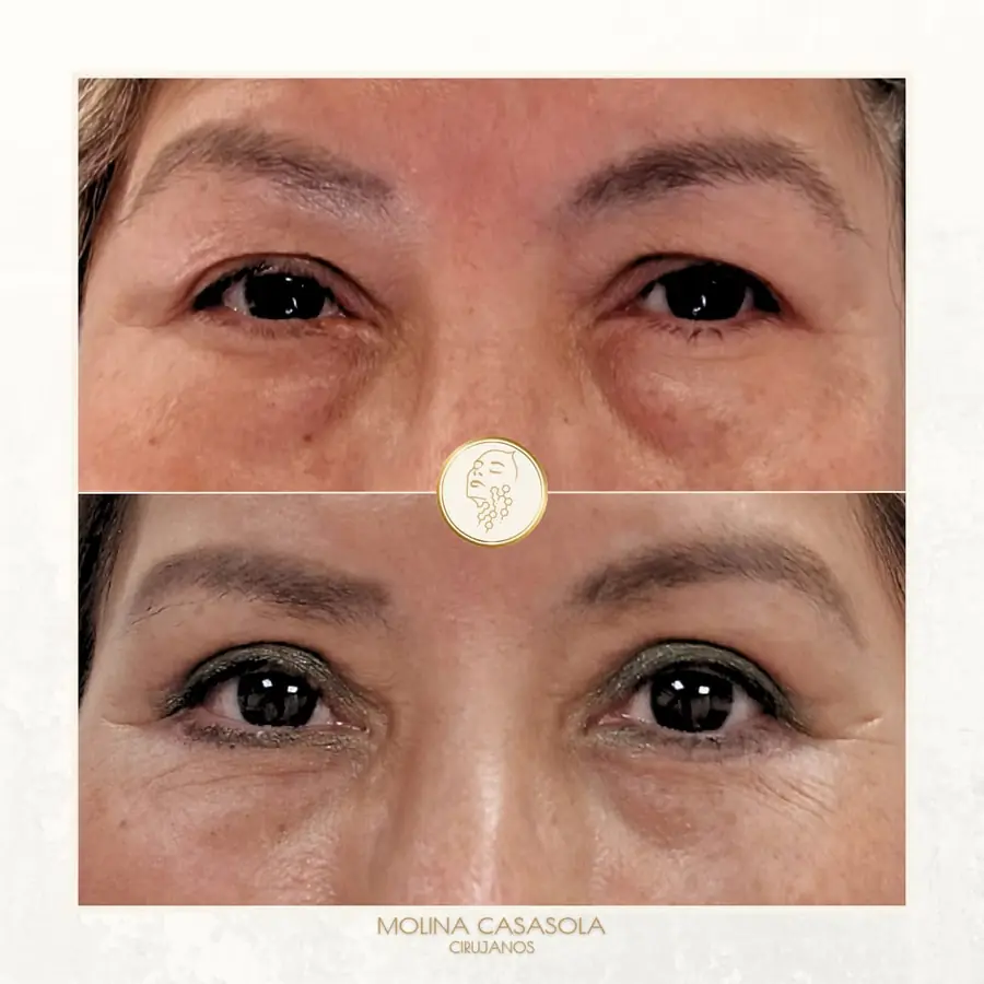 Antes y después de blefaroplastia completa, paciente de la clínica