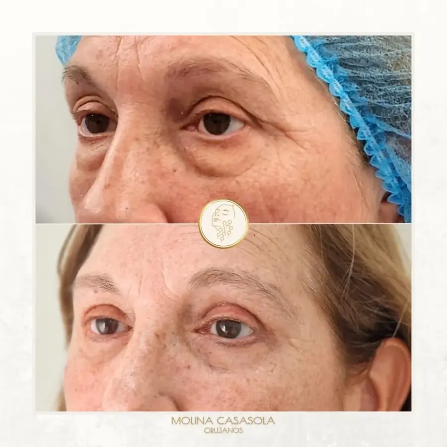 Antes y después de blefaroplastia completa, paciente de la clínica