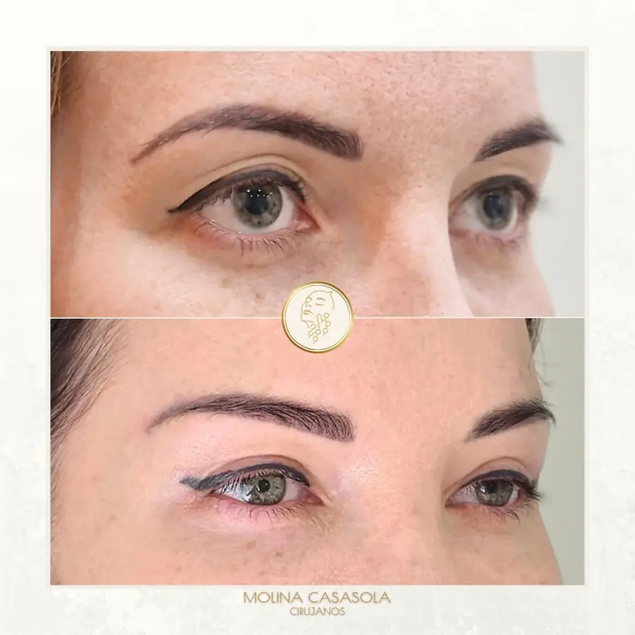 Antes y después de lifting de cejas, paciente de la clínica